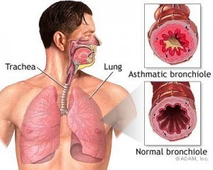 Penyakit Asma Bronkial