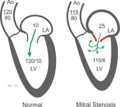 Petunjuk Diagnosis Stenosis Mitral