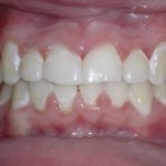 gigi goyang berawal dari penyakit gusi