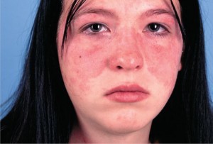 Jenis-jenis Penyakit Lupus