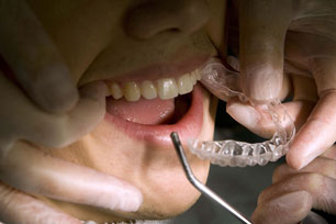 Cara Merawat Kesehatan Gigi Bagi Pengguna Behel