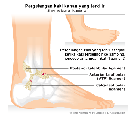 Ramuan Obat tradisional untuk kaki terkilir