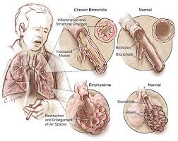 Tips Sehat Mengobati Penyakit Bronchitis
